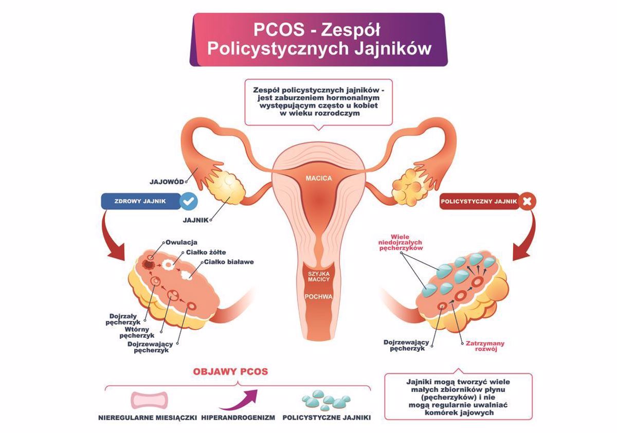 Źródło: https://www.synevo.pl/zespol-policystycznych-jajnikow-pcos/